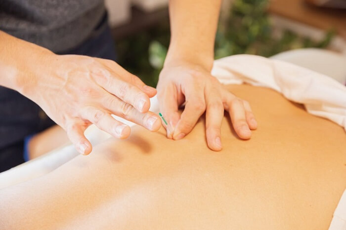 what is acupuncture